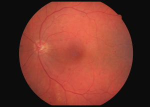 retinografia di un paziente diabetico